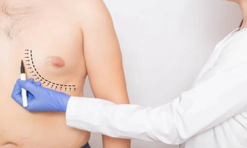 Imagem ilustrativa da imagem 4.100 homens buscam cirurgia para reduzir mama