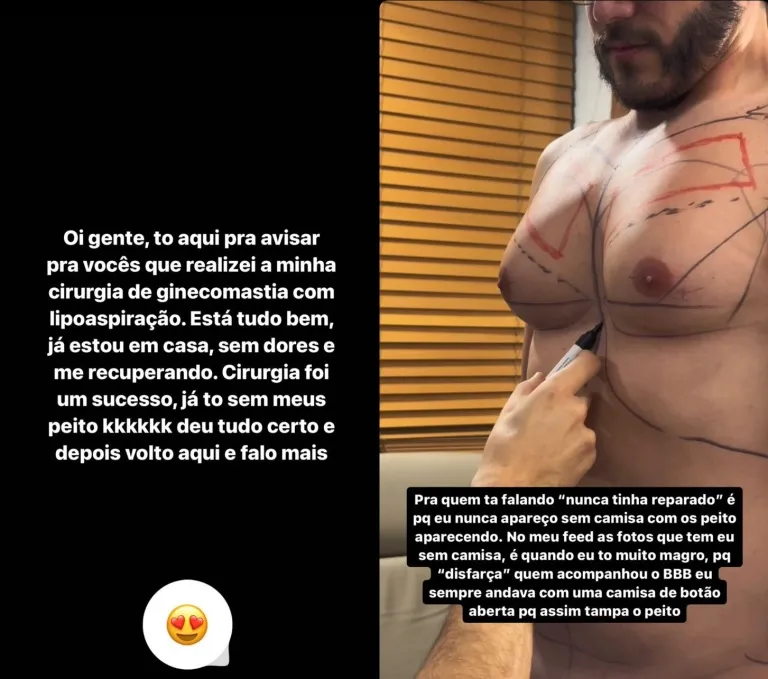 Imagem ilustrativa da imagem Veja o antes e depois das cirurgias plásticas do ex-BBB Eliezer