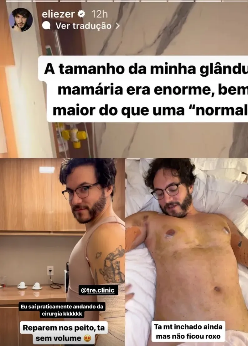 Imagem ilustrativa da imagem Veja o antes e depois das cirurgias plásticas do ex-BBB Eliezer