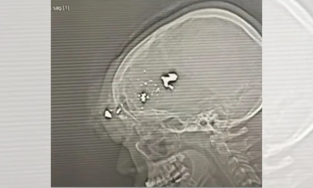 Imagem ilustrativa da imagem Raio-x mostra bala alojada na cabeça de influenciador Meno Kabrinha