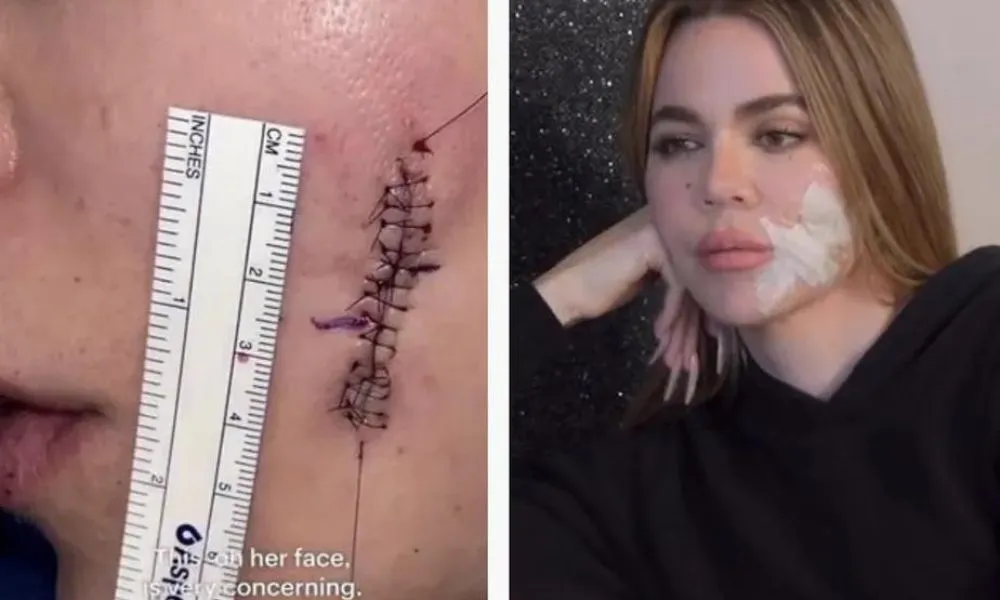 Imagem ilustrativa da imagem Khloé Kardashian mostra cicatriz no rosto após cirurgia e ganha elogios
