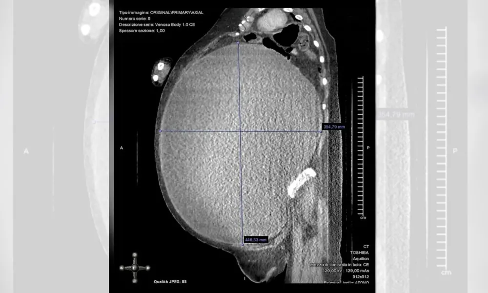 Imagem ilustrativa da imagem Mulher perde 53 kg após passar por cirurgia para remover cisto gigante