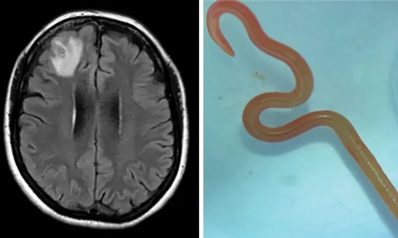 Imagem ilustrativa da imagem Verme comum em cobras é achado no cérebro humano pela primeira vez