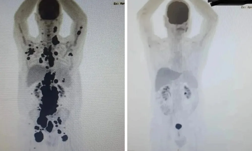 Imagem ilustrativa da imagem Paciente com câncer há 13 anos tem remissão total com terapia inovadora em SP