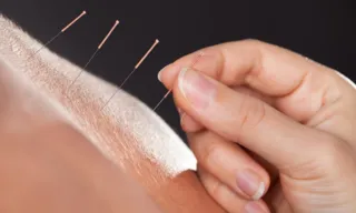 Imagem ilustrativa da imagem Entenda o que já foi comprovado ou não sobre a prática de acupuntura