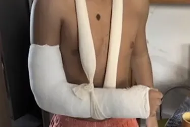 Imagem ilustrativa da imagem Adolescente quebra o pulso após encostar em corrimão de ponte e levar choque