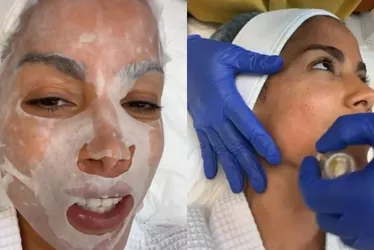 Imagem ilustrativa da imagem Anitta exibe detalhes de tratamento estético com o próprio sangue