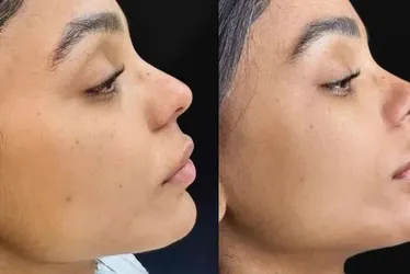 Imagem ilustrativa da imagem Esposa de Ludmilla faz nova harmonização facial e mostra mudanças
