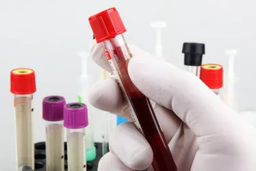 Imagem ilustrativa da imagem Exame de sangue que aponta Alzheimer pode chegar ao país em um mês