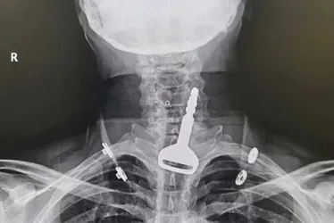 Imagem ilustrativa da imagem Homem é salvo de asfixia após chave do carro ficar entalada na traqueia