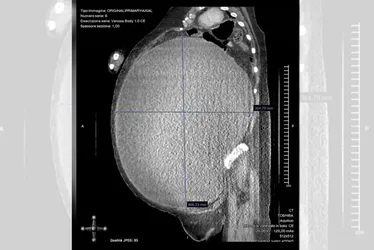 Imagem ilustrativa da imagem Mulher perde 53 kg após passar por cirurgia para remover cisto gigante