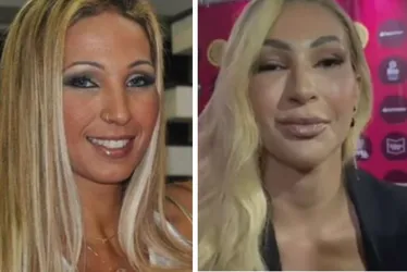 Imagem ilustrativa da imagem VÍDEO | Valesca Popozuda faz harmonização facial e choca com novo rosto