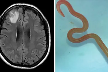 Imagem ilustrativa da imagem Verme comum em cobras é achado no cérebro humano pela primeira vez