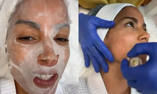 
          Imagem ilustrativa da imagem Anitta exibe detalhes de tratamento estético com o próprio sangue
          