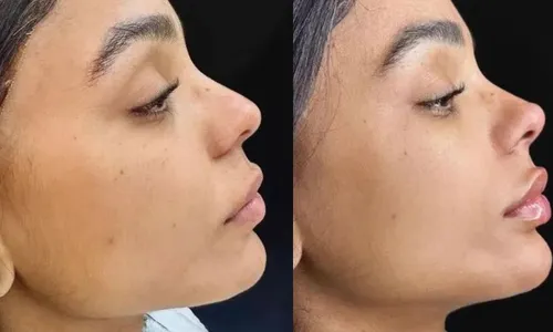 
          Imagem ilustrativa da imagem Esposa de Ludmilla faz nova harmonização facial e mostra mudanças
          