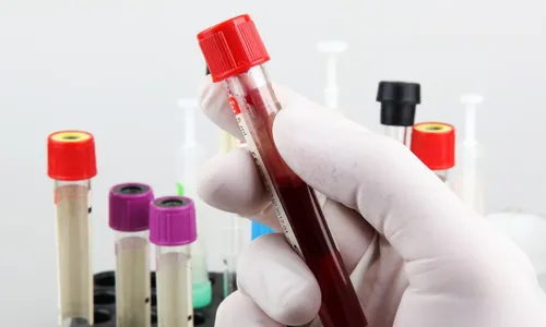 
          Imagem ilustrativa da imagem Exame de sangue que aponta Alzheimer pode chegar ao país em um mês
          