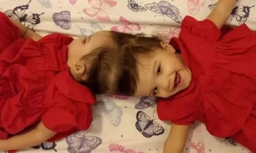 
          Imagem ilustrativa da imagem Gêmeas siamesas passam bem um dia após a cirurgia de separação
          