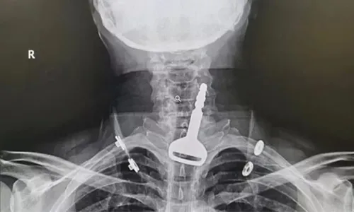 
          Imagem ilustrativa da imagem Homem é salvo de asfixia após chave do carro ficar entalada na traqueia
          