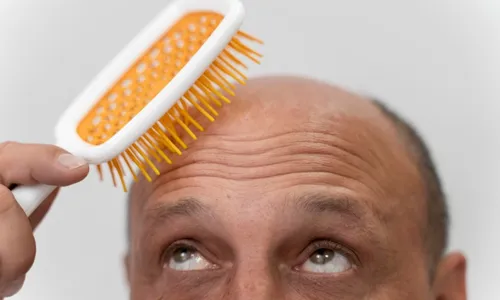 
          Imagem ilustrativa da imagem Lista mostra os 21 países com mais carecas no mundo
          