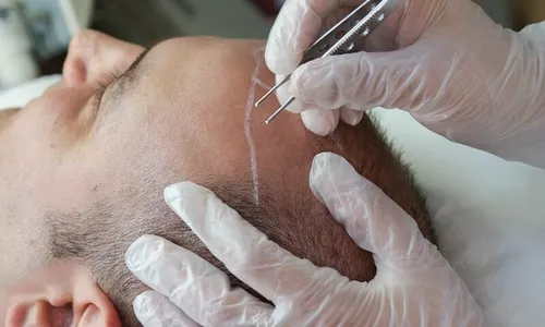 
          Imagem ilustrativa da imagem Mulheres fazem transplante para disfarçar queda dos fios
          