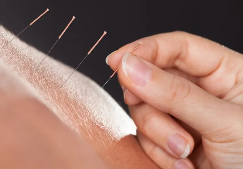 Surgida há pelo menos 2.000 anos, a acupuntura consiste em puncionar com agulhas metálicas pontos específicos na pele
