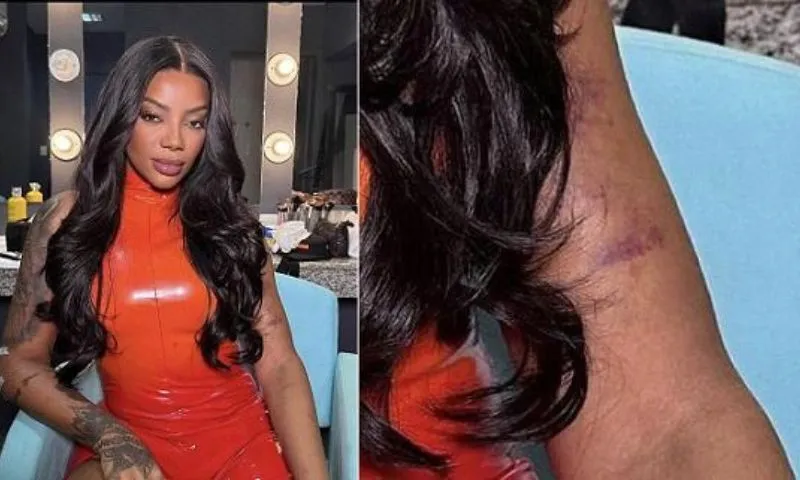 Imagem ilustrativa da imagem Ludmilla assusta fãs ao publicar foto cheia de hematomas