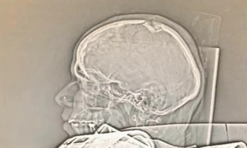 Imagem ilustrativa da imagem Grávida atingida por pedaço de poste sofre fratura no crânio e passará por cirurgia