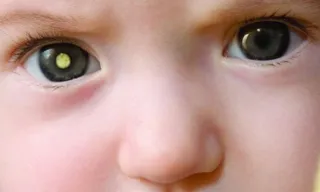 Imagem ilustrativa da imagem Olho de gato em criança é alerta de tumor ocular maligno