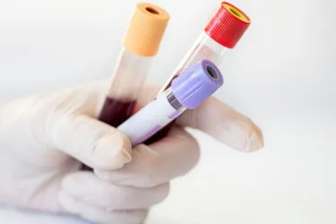 Imagem ilustrativa da imagem Exame de sangue para diagnóstico de Alzheimer chega ao Brasil