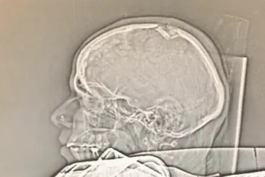 Imagem ilustrativa da imagem Grávida atingida por pedaço de poste sofre fratura no crânio e passará por cirurgia