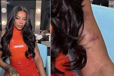 Imagem ilustrativa da imagem Ludmilla assusta fãs ao publicar foto cheia de hematomas