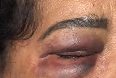 Imagem ilustrativa da imagem Manicure é agredida pelo ex-marido após se recusar a cozinhar