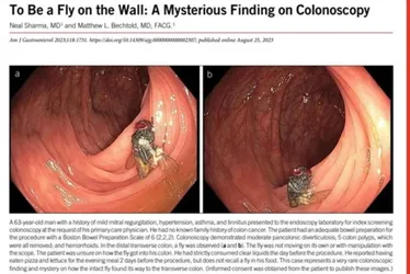 Imagem ilustrativa da imagem Médicos encontram mosca intacta em intestino de idoso nos EUA