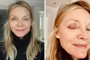 Imagem ilustrativa da imagem Michelle Pfeiffer aparece com olho roxo; entenda