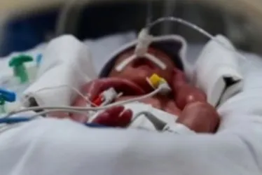 Imagem ilustrativa da imagem Morre Theo, um dos sêxtuplos de Colatina