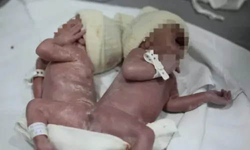 
          Imagem ilustrativa da imagem Em caso raro, gêmeos siameses nascem unidos por osso da coluna no PR
          