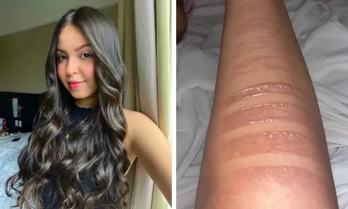 
          Imagem ilustrativa da imagem Fãs de Taylor Swift relatam queimaduras graves e dizem que vão processar produtora
          