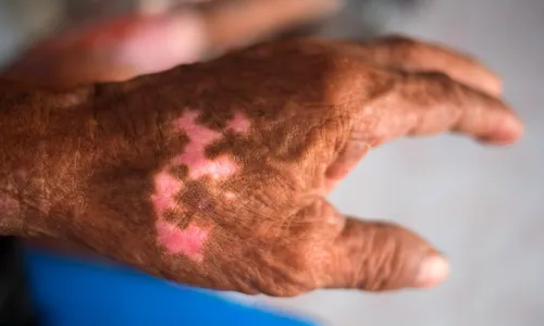 
          Imagem ilustrativa da imagem Filhos de pessoas isoladas por hanseníase em colônias no passado vão receber pensão
          