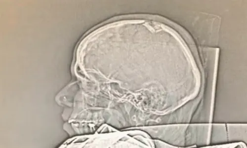 
          Imagem ilustrativa da imagem Grávida atingida por pedaço de poste sofre fratura no crânio e passará por cirurgia
          