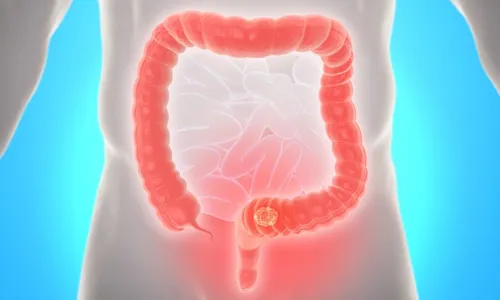 
          Imagem ilustrativa da imagem Mortes por câncer colorretal na América Latina crescem 20,5% em 30 anos
          