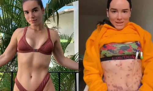 
          Imagem ilustrativa da imagem Mulher pega bactéria comedora de carne após aplicar injeção para queimar gordura
          