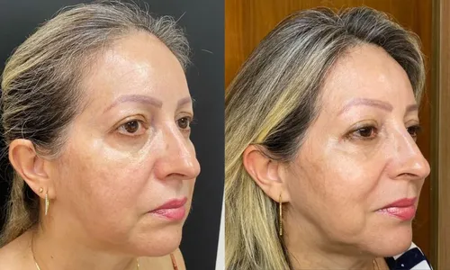 
          Imagem ilustrativa da imagem Opção por cirurgias ou procedimentos estéticos por influência das redes sociais
          