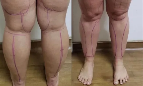 
          Imagem ilustrativa da imagem “Sofri muito”, diz empresária que descobriu lipedema
          