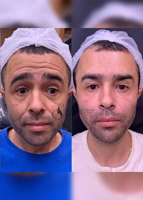 Imagem ilustrativa da imagem Motorista que atropelou Kayky Brito faz harmonização facial e vira influencer