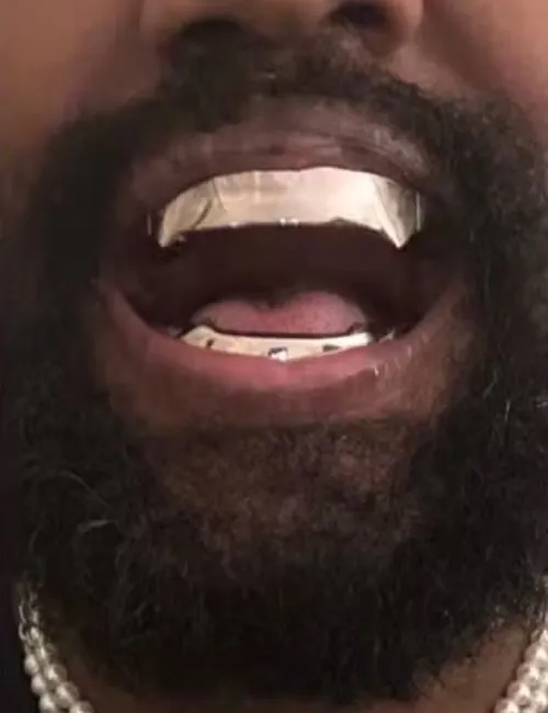 Imagem ilustrativa da imagem Kanye West coloca prótese de titânio de R$ 4 milhões nos dentes