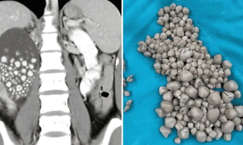 Imagem ilustrativa da imagem Pedra nos rins atinge cada vez mais crianças, diz médico