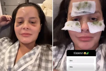 Imagem ilustrativa da imagem Após quebrar o nariz, Maraisa mostra hematomas no rosto e brinca: 'Estou bonita?'