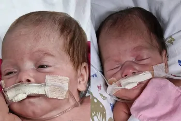Imagem ilustrativa da imagem Gêmeos de Colatina: Eloá e Maytê vão receber alta do hospital nesta quarta-feira