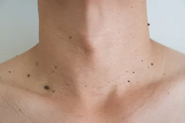 Imagem ilustrativa da imagem Médico diz quando pintas no corpo devem preocupar