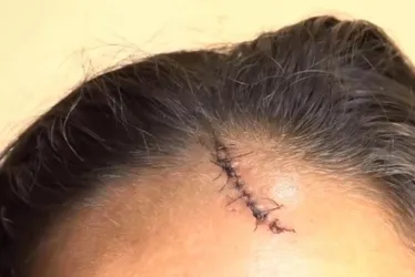 Imagem ilustrativa da imagem Mulher é agredida pelo ex-marido com garrafada na cabeça durante briga em Cariacica